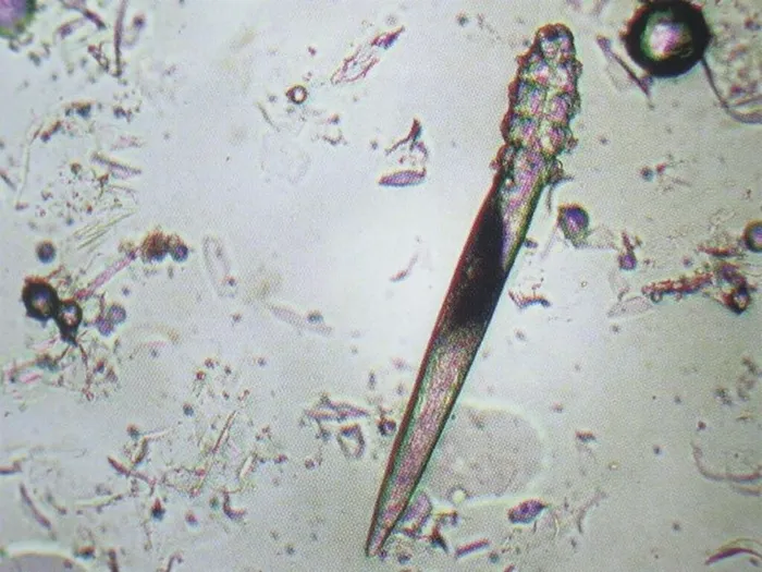 demodekoz_demodex